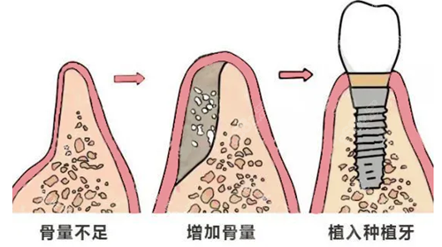 种植牙必须要植骨吗