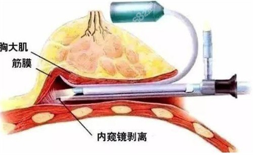 上海殷初阳医生内窥镜丰胸
