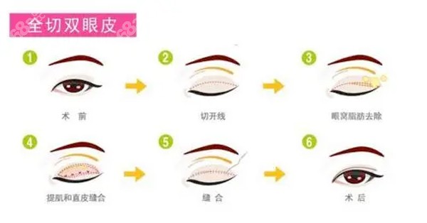 全切双眼皮手术流程