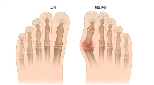 正常拇指骨骼与外翻骨骼对比