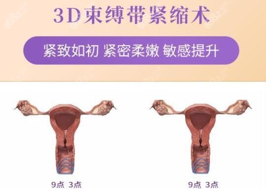 北京侯智慧做3D生物束带紧缩术好