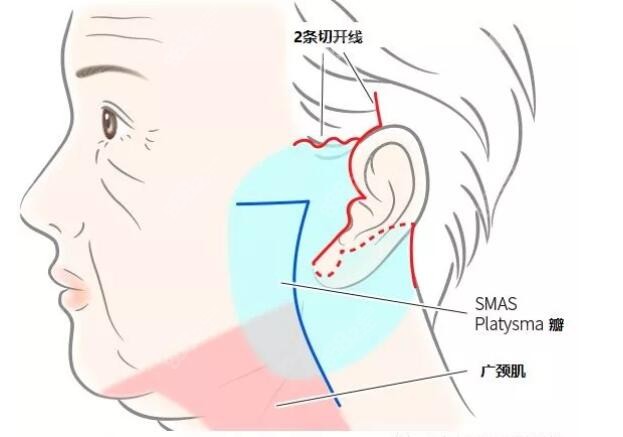 王志军大拉皮手术技术图