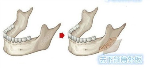 磨骨医生黄大勇怎么预约？