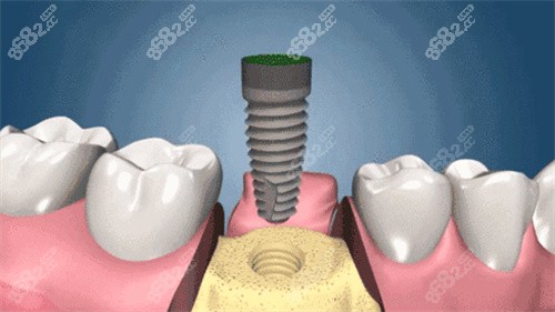 种植体植入过程动画图