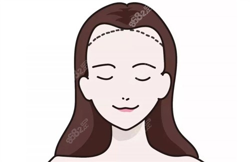 M型发际线后移