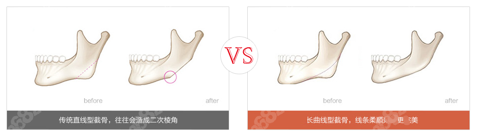 长曲线截骨侧面改善明显但价格贵