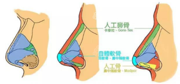 韩国TS整形医院鼻修复