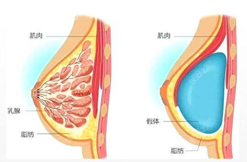 韩国爱我整形隆胸技术图