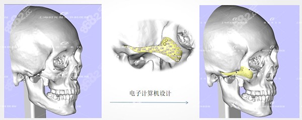 上海时光整形颧骨颧弓怎么样