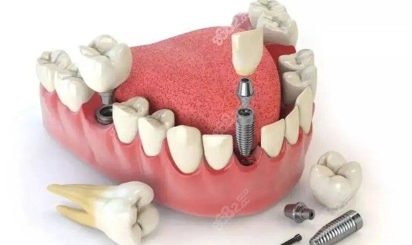 牡丹江張月鵬口腔種植牙價格