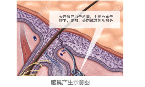 腋臭产生的原因示意图