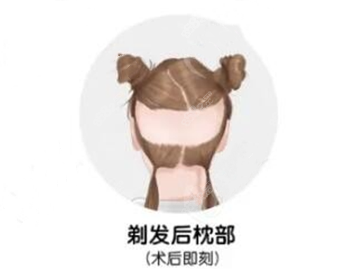 剃发植发