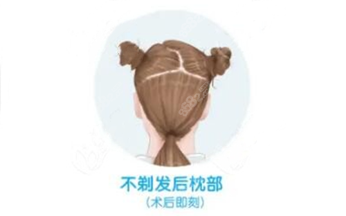 不剃发植发