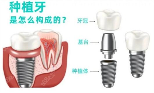 乌鲁木齐种牙选天牙口腔和美奥口腔哪个好