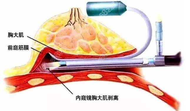 假体隆胸技术好www.8682.cc/