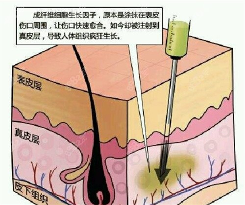 广州林彪斌取生长因子怎么样