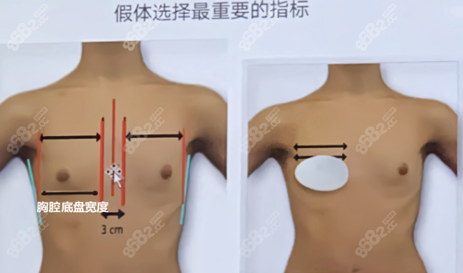 型腔基底宽度是隆胸假体选择重要指标