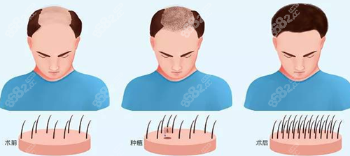 不剃发植发