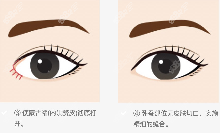 崔文燮医生做开内眼角的特点