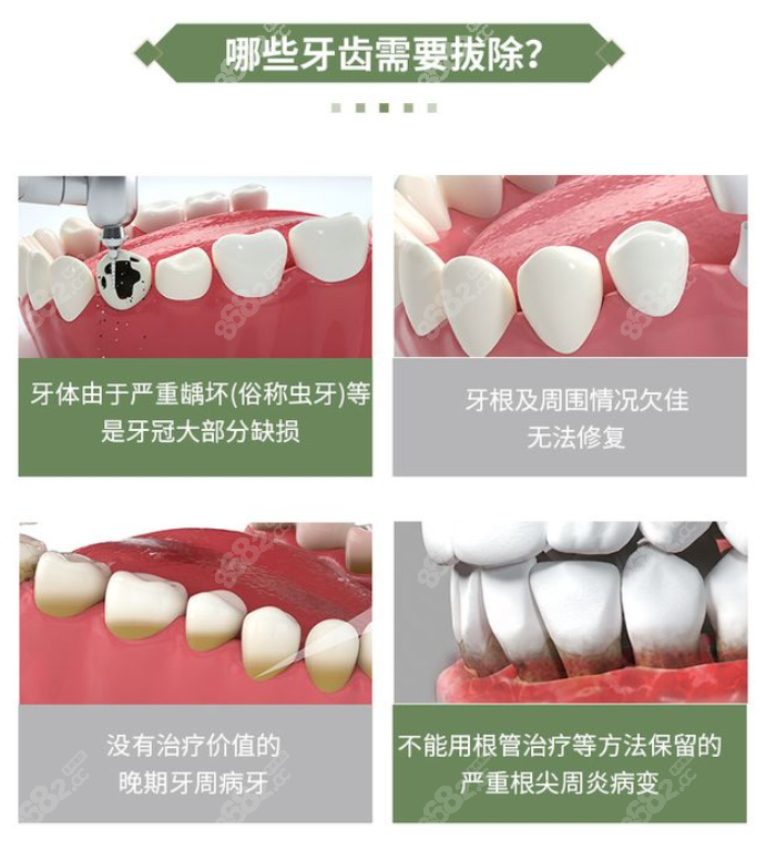 内江拔智齿多少钱一颗 