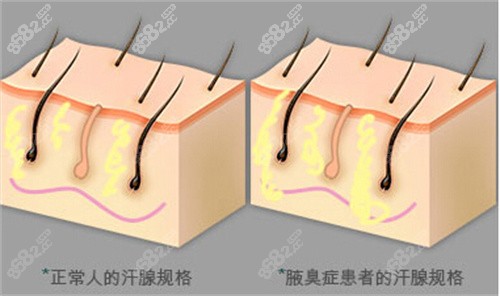 汗腺破除是狐臭治疗的有效方法