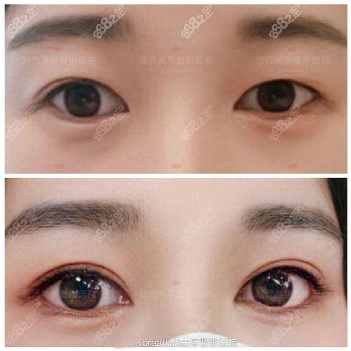 做完双眼皮埋线脱落，重新做了二次双眼皮修复