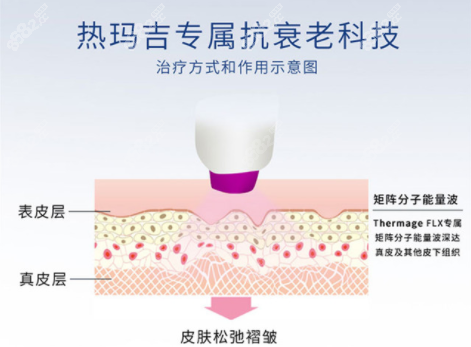 热玛吉原理