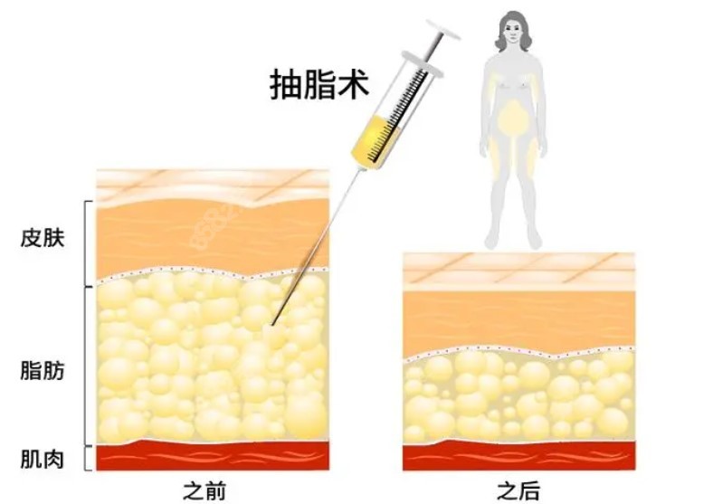 广州吸脂好的医生抽脂技术优势8682网分享