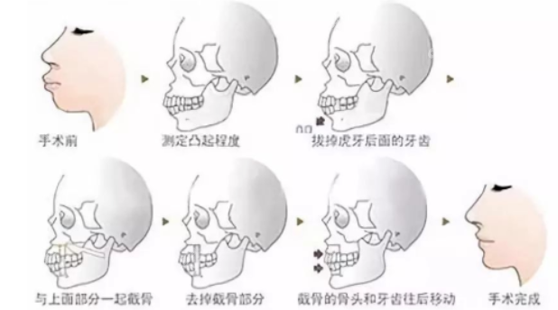 正颌手术过程图解