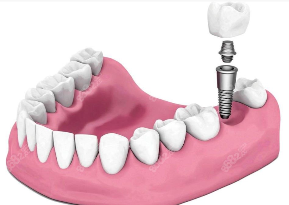 东莞种植牙集采后价格便宜8682.cc