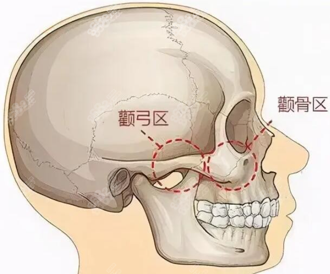 颧骨手术图示