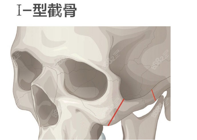 颧骨I型截骨和L型截骨哪个好