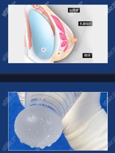 殷初阳医生隆胸技术怎样www.8682.cc