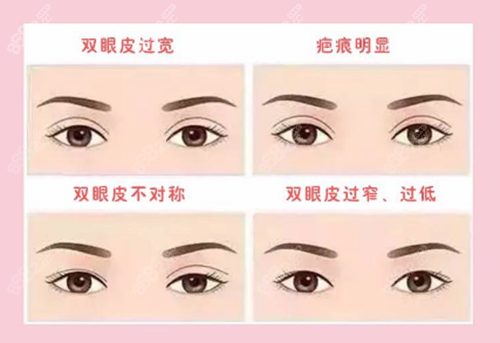 雙眼皮失敗的各類情況