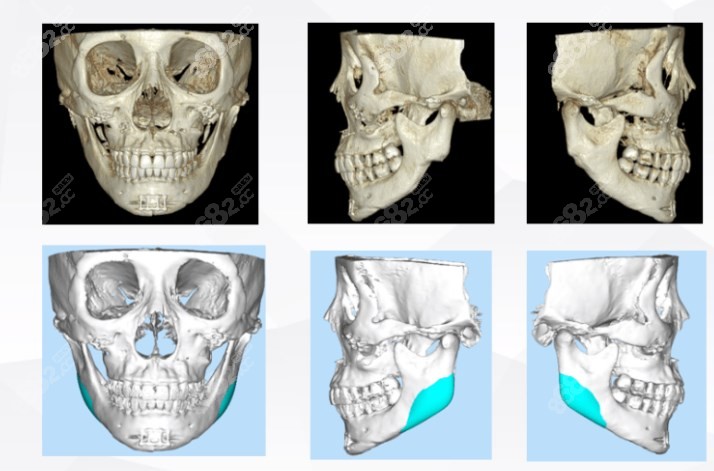 韩国eu医院下颌角缺失修复实例