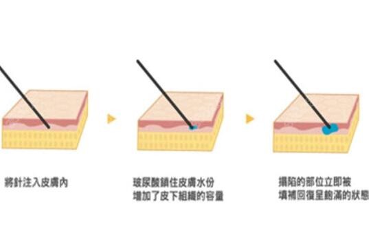 北京玻尿酸填充价格查询