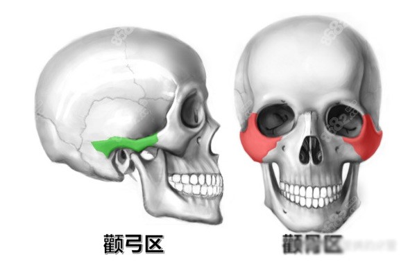 颧骨颧弓l形截骨还是L截骨好