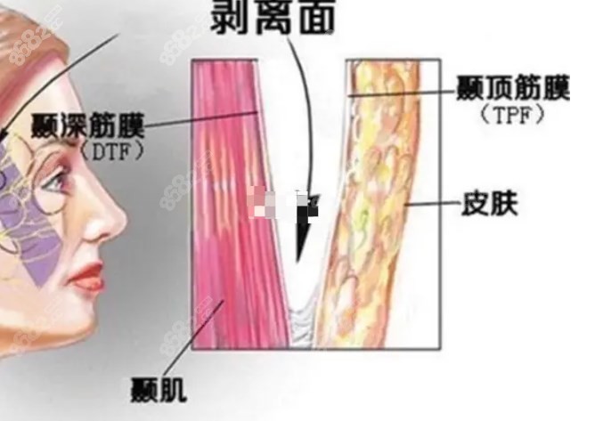 北京煤医王驰拉皮对比图片www.8682.cc