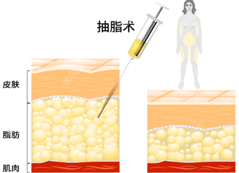 成都艾米丽整形医院吸脂修复手术