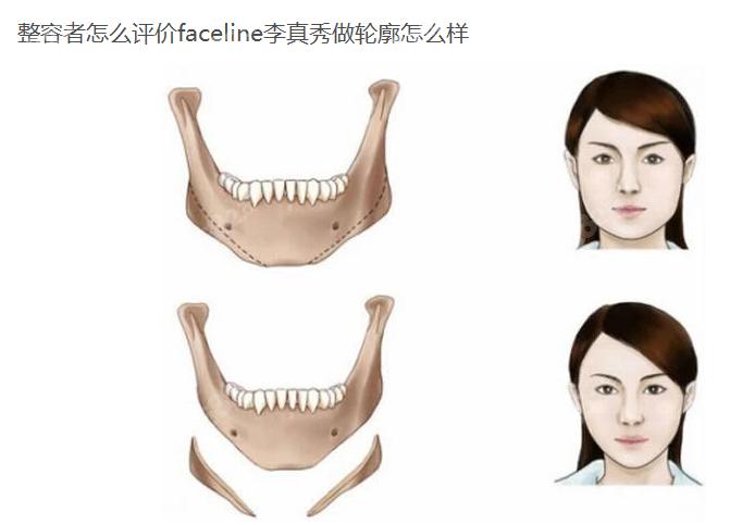 整容者怎么评价faceline李真秀做轮廓怎么样