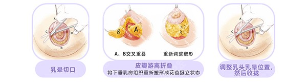 深圳南雅花苞提胸术技术优势