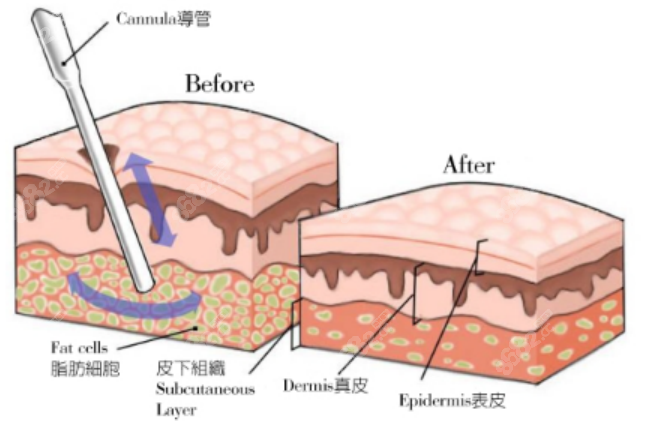 <!--<i data=20240705-sp></i>-->医生吸脂