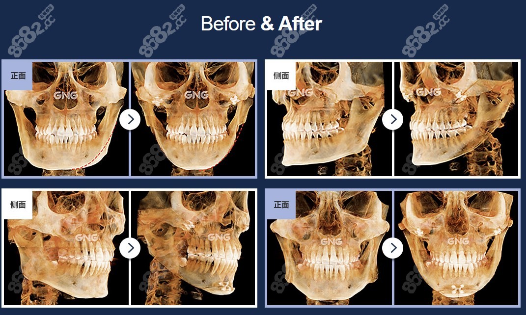 韩国gng医院下颌角手术前后CT照对比