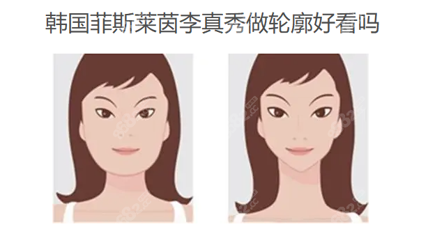 韩国菲斯莱茵李真秀做轮廓好看吗