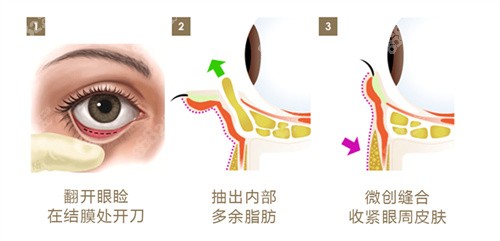 内切去眼袋手术图片