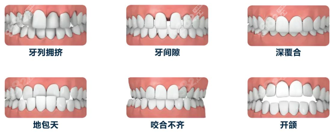 佛山牙齿矫正好的医院可以矫正的牙齿