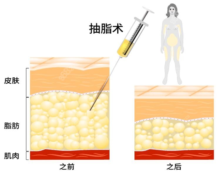 吸脂手术的原理