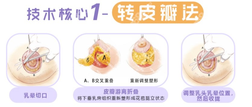 乳房花苞提升术原理介绍8682网
