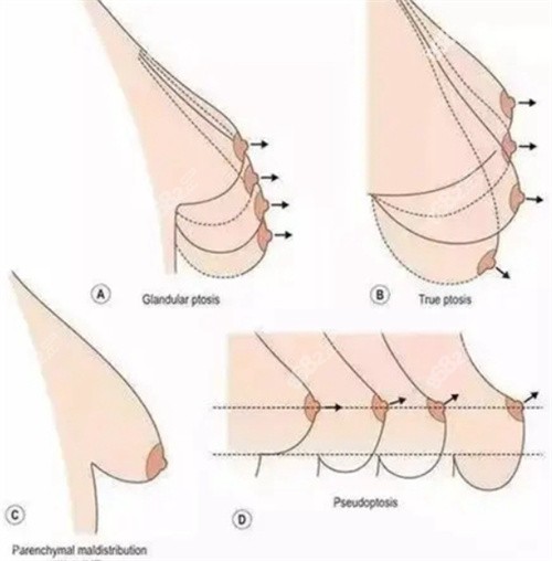 乳房下垂人工韧带提升术哪家可以做?