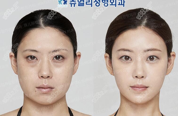 珠儿丽整形外科顾客术前术后